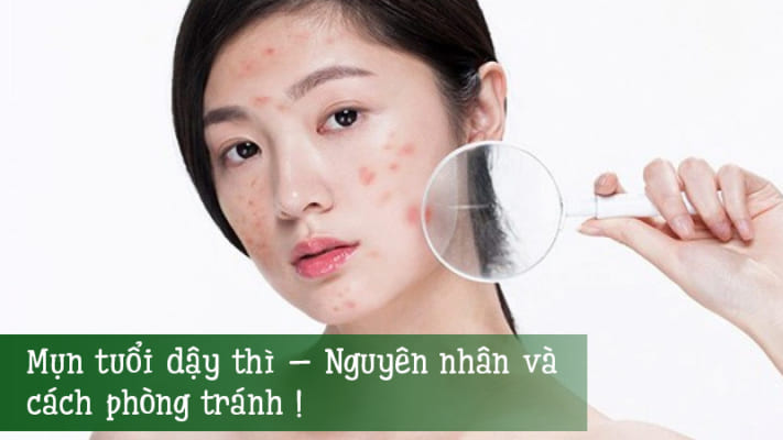 Mụn-tuổi-dậy-thì-–-Nguyên-nhân-và-cách-phòng-tránh