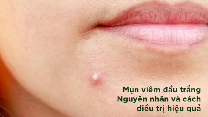 Mụn-viêm-đầu-trắng-Nguyên-nhân-và-cách-điều-trị-hiệu-quả (1)